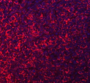Immunofluorescent staining of FFPE human breast cancer tissue with Acyl-CoA dehydrogenase family member 9 antibody (red) and DAPI nuclear stain (blue). HIER: steam section in pH8 EDTA buffer for 20 min.