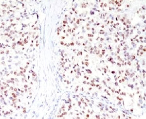 IHC testing of FFPE human melanoma with MITF antibody (clone MPAF3). Staining of formalin-fixed tiss