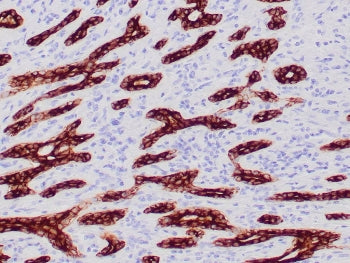 IHC staining of FFPE human breast carcinoma tissue with Cytokeratin CAM5.2 antibody (clone CAM5.2). 