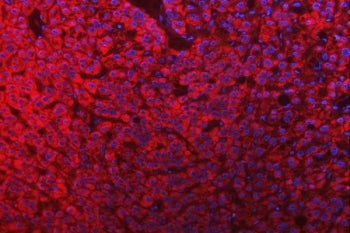 Immunofluorescent staining of FFPE human liver cancer tissue with SLC25A10 antibody (red) and DAPI n