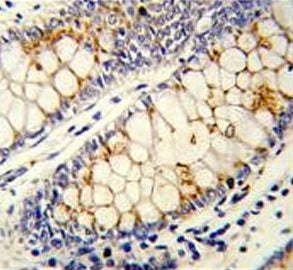 IHC testing of FFPE human colon carcinoma tissue with SRSF1 antibody. HIER: steam section in pH6 cit