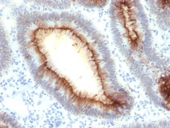 IHC testing of FFPE human colon carcinoma with CEA antibody (clone rC66/1009). Required HIER: boil t