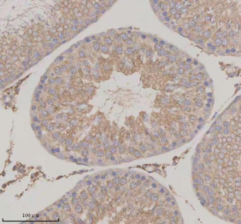 Immunohistochemical staining of SERPINE2 using anti-SERPINE2 antibody. SERPINE2 was detected in a pa