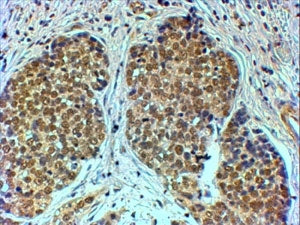 IHC testing of FFPE human breast cancer with TIF1A antibody at 4ug/ml. HIER: steamed with pH6 citrat