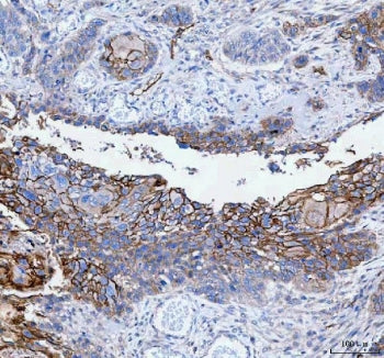 IHC staining of FFPE human esophageal squamous carcinoma tissue with Paralemmin antibody. HIER: boil