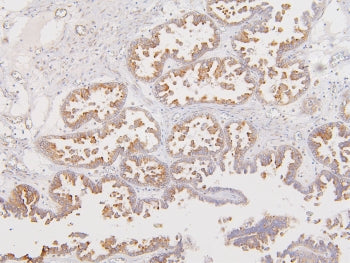 IHC staining of FFPE human ovarian cancer with ATP5MC1/2/3 antibody. HIER: boil tissue sections in p
