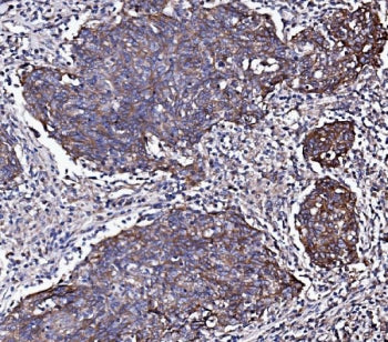 IHC staining of FFPE human lung cancer with EGF Receptor antibody. HIER: boil tissue sections in pH8