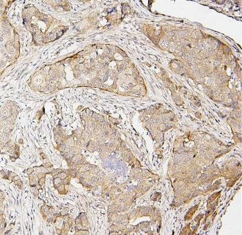 IHC staining of FFPE human breast cancer with IRF3 antibody. HIER: boil tissue sections in pH8 EDTA 