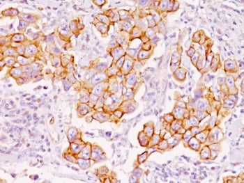 IHC: Formalin-fixed, paraffin-embedded human breast carcinoma stained with Phosphotyrosine antibody 