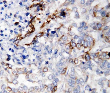 IHC staining of FFPE human lung cancer tissue with LAMC2 antibody. HIER: boil tissue sections in pH8