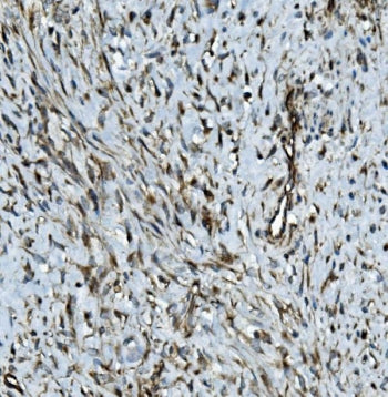 IHC staining of FFPE human breast cancer with MMP2 antibody. HIER: boil tissue sections in pH8 EDTA 