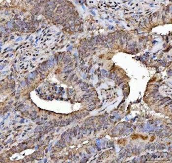 IHC staining of FFPE human colorectal adenocarcinoma tissue with NELF antibody. HIER: boil tissue se