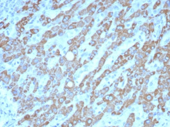 IHC staining of FFPE human hepatocellular carcinoma tissue with CPS1 antibody (clone CPS1/8420). HIE