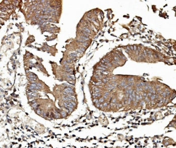 IHC staining of FFPE human rectal cancer with TAB2 antibody. HIER: boil tissue sections in pH8 EDTA 