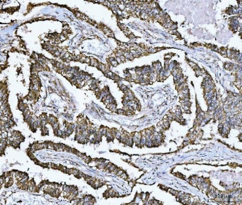 IHC staining of FFPE human lung adenocarcinoma tissue with SDHB antibody. HIER: boil tissue sections