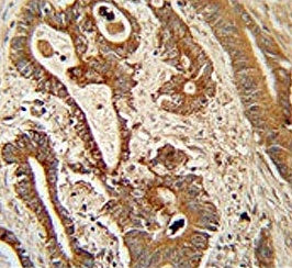 IHC testing of FFPE human colon carcinoma tissue with ETHE1 antibody. HIER: steam section in pH6 cit
