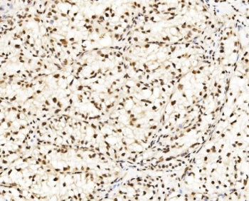 IHC staining of FFPE human renal clear cell carcinoma tissue with CCAR2 antibody. HIER: boil tissue 