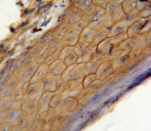 CB2 antibody immunohistochemistry analysis in formalin fixed and paraffin embedded human skin carcin
