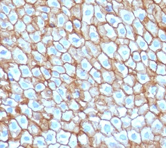 IHC staining of FFPE human esophageal carcinoma with DSG3 antibody (clone CFM6-1). HIER: boil tissue