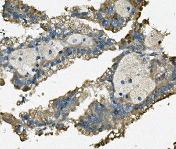 IHC staining of FFPE human renal cancer with TTC11 antibody. HIER: boil tissue sections in pH8 EDTA 
