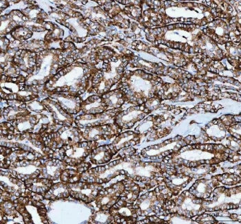 IHC staining of FFPE human thyroid papillary carcinoma tissue with Josephin 2 antibody. HIER: boil t