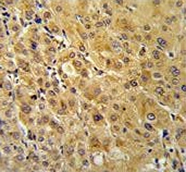 IHC testing of FFPE human hepatocellular carcinoma tissue with FKBP1A antibody. HIER: steam section 