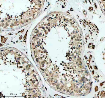Immunohistochemical staining of SKA3 using anti-SKA3 antibody. SKA3 was detected in a paraffin-embed