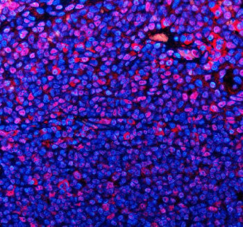 Immunofluorescent staining of TMC6 using anti-TMC6 antibody (red). TMC6 was detected in a paraffin-e