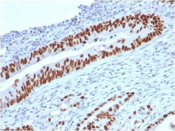 IHC staining of FFPE human colon carcinoma with p53 antibody (clone TP53/2719). HIER: boil tissue se