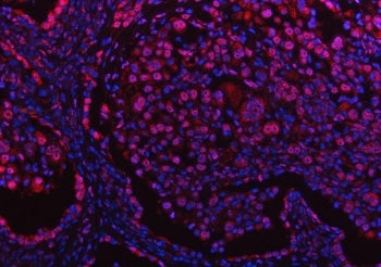 Immunofluorescent staining of FFPE human lung cancer tissue with Protein phosphatase 1G antibody (re