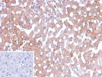 IHC staining of FFPE human hepatocellular carcinoma tissue with 17-beta-hydroxysteroid dehydrogenase