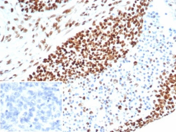 IHC staining of FFPE human ovarian carcinoma tissue with MSH6 antibody (clone MSH6/7064R). Inset: PB