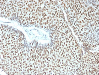 IHC testing of FFPE human cervical tumor with phospho-c-Jun antibody (clone C-J 4C4/1). HIER: boil t