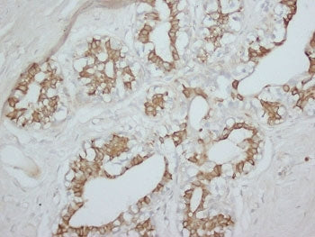 IHC staining of FFPE human breast cancer tissue with PKC alpha antibody. HIER: boil tissue sections 