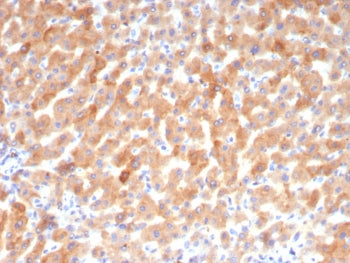 IHC staining of FFPE human hepatocellular carcinoma tissue with Transferrin antibody (clone TF/4794)