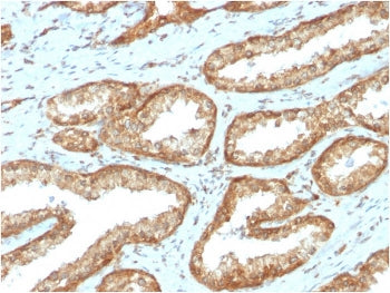 IHC staining of FFPE human prostate carcinoma with YB-1 antibody (clone YBX1/2430). HIER: boil tissu
