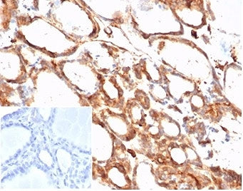 IHC staining of FFPE human thyroid tissue with Beta Actin (clone ACTB/1108). Negative control inset: PBS instead of primary antibody to control for secondary binding. HIER: boil tissue sections in pH 9 10mM Tris with 1mM EDTA for 20 min and allow to cool before testing.