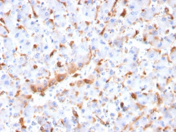 IHC staining of FFPE human hepatocellular carcinoma with C1QB antibody. HIER: boil tissue sections i