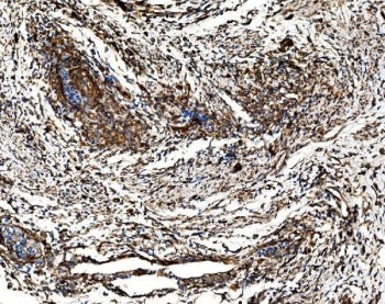 IHC staining of FFPE human cervical cancer tissue with G3BP1 antibody. HIER: boil tissue sections in