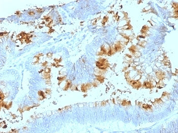IHC: Formalin-fixed, paraffin-embedded human colon carcinoma stained with Blood Group Lewis a antibo