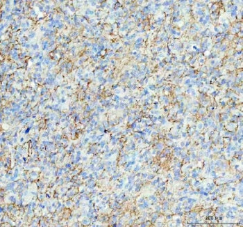 IHC staining of FFPE human glioma tissue with Aquaporin 4 antibody. HIER: boil tissue sections in pH