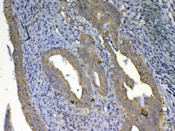 IHC testing of FFPE human rectal cancer tissue with UGT1A1 antibody at 1ug/ml. Required HIER: steam 