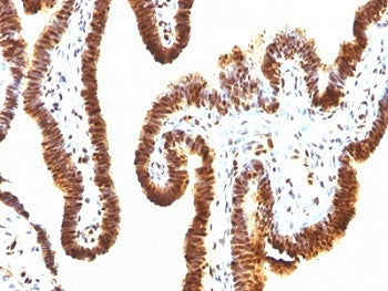 IHC: Formalin-fixed, paraffin-embedded human ovarian carcinoma stained with anti-SUMO-1 antibody (cl