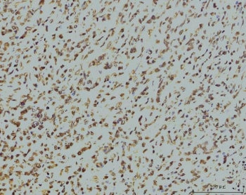 IHC staining of FFPE human stomach cancer tissue with Replication Protein A2 antibody. HIER: boil ti