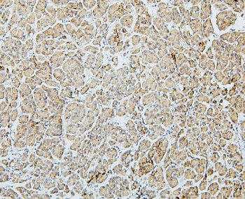 IHC staining of FFPE human pancreatic cancer with MTR antibody. HIER: boil tissue sections in pH6, 1