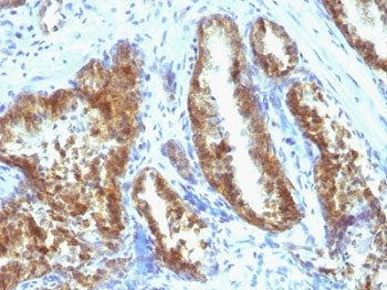 IHC: Formalin-fixed, paraffin-embedded human prostate carcinoma stained with Prostate Specific Antig