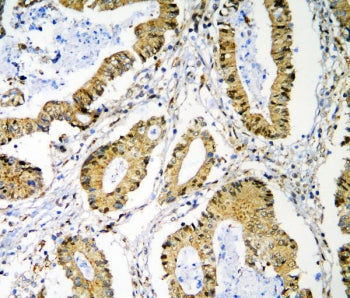 IHC staining of FFPE human rectal cancer with PRMT1 antibody. HIER: boil tissue sections in pH6, 10m