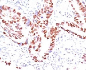 IHC: Formalin-fixed, paraffin-embedded human colon carcinoma stained with p57 antibody (clone KIP2/8
