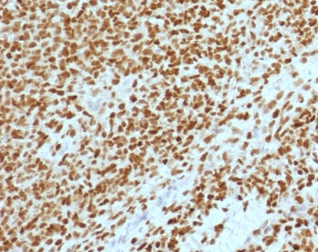 IHC testing of FFPE Ewings sarcoma with NKX2.2 antibody (clone RMNK2-2). HIER: steam sections in pH 