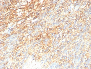 IHC staining of FFPE human GIST tissue with recombinant CD117 antibody (clone rC117/9253. HIER: boil